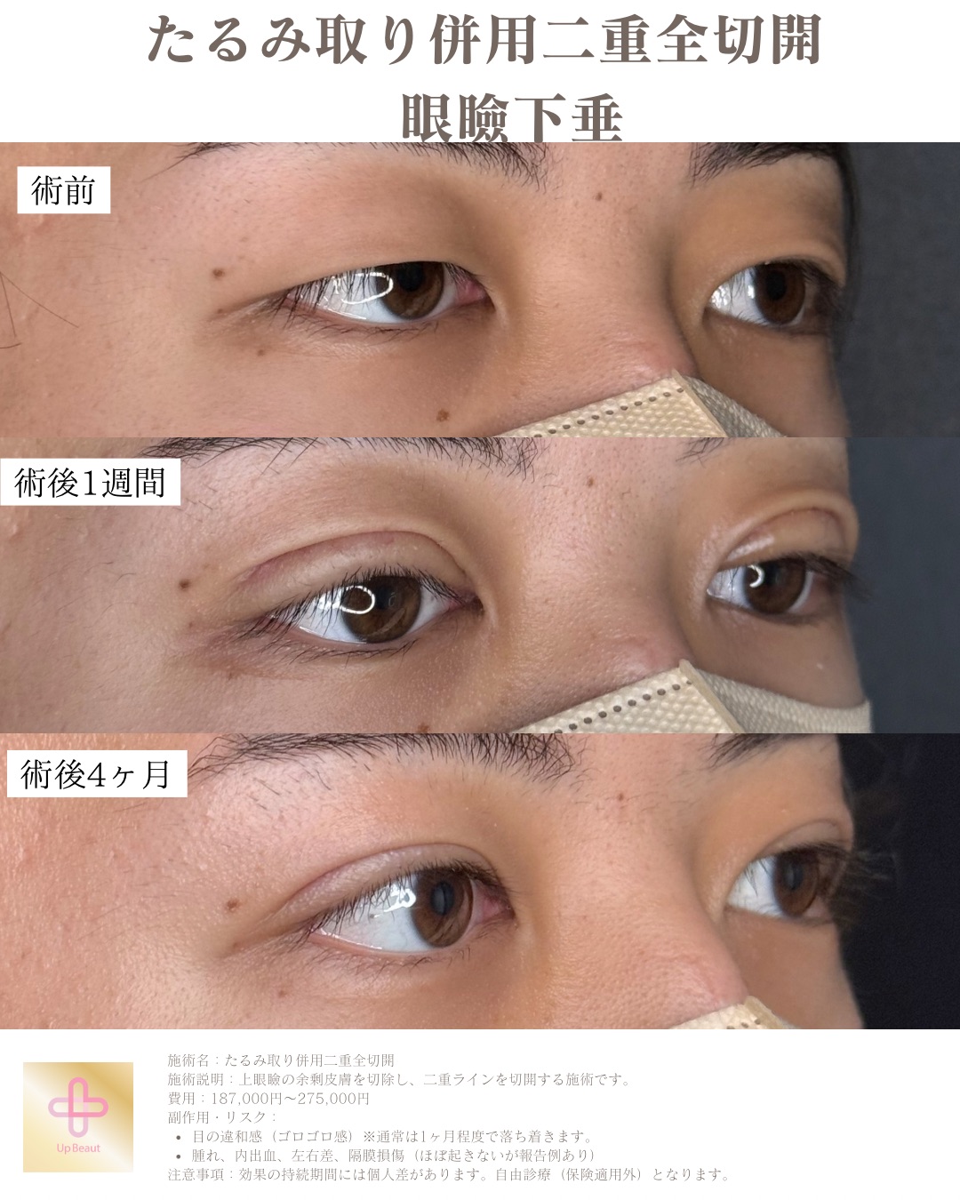 二重整形　眼瞼下垂　男性ビフォーアフター症例写真