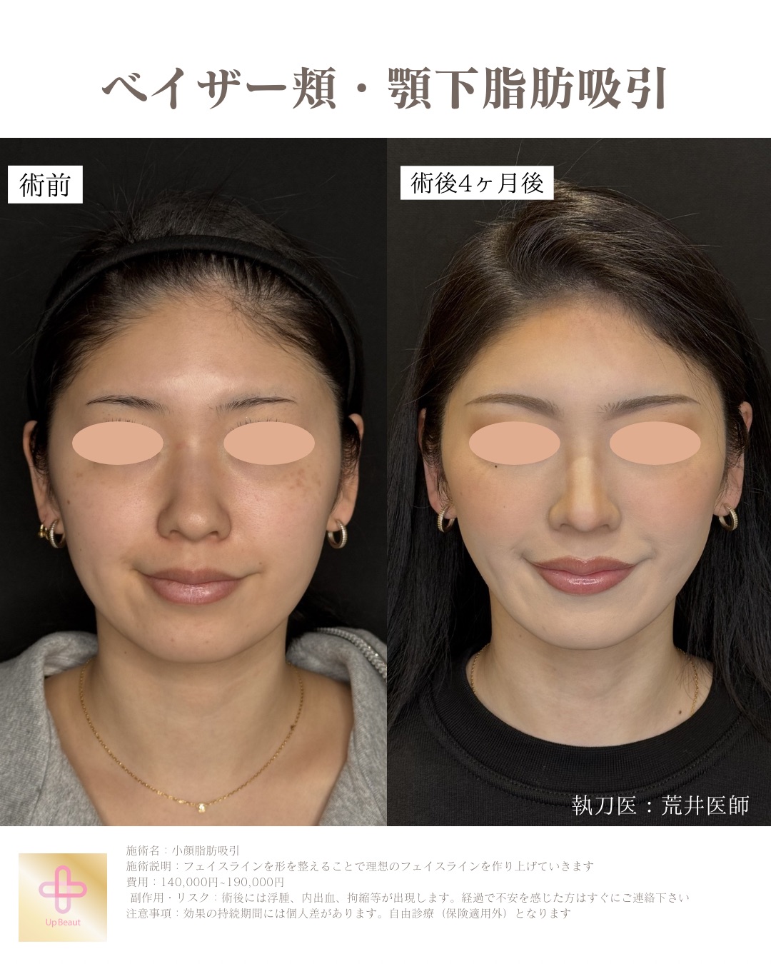 ベイザー小顔脂肪吸引 二重顎・フェイスラインの症例写真 横顔（ビフォーアフター）