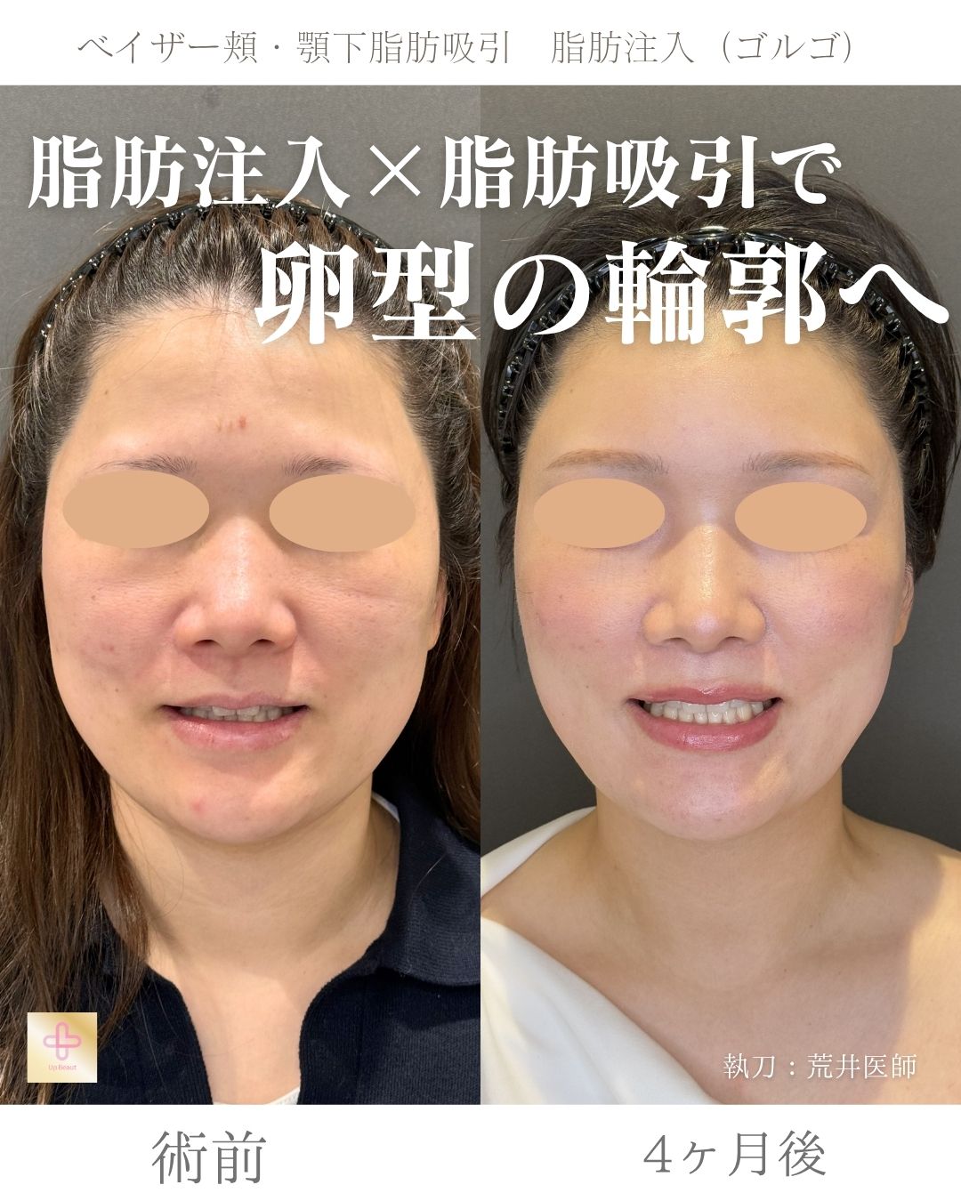 小顔脂肪吸引、ゴルゴ脂肪注入