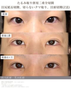 目尻延長切開　症例写真