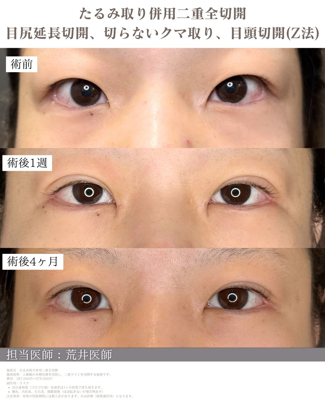 目尻延長切開　症例写真