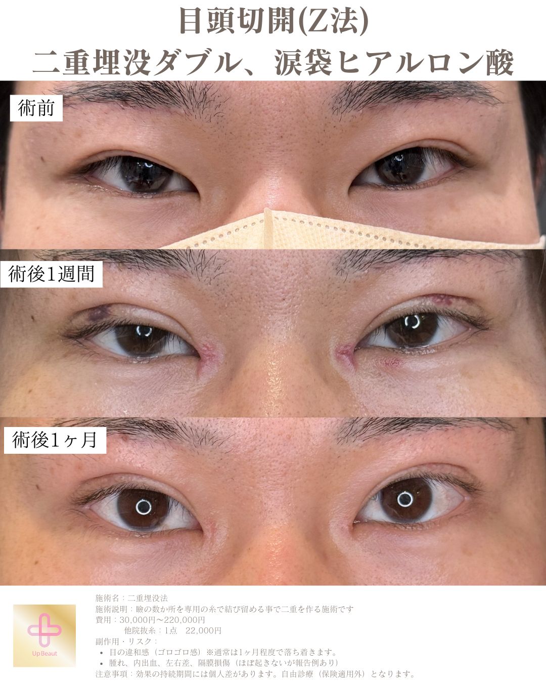 二重埋没法 2点留め 症例1