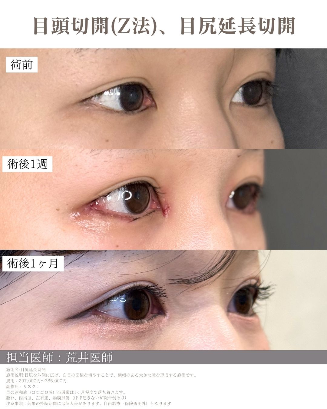 目尻延長切開症例