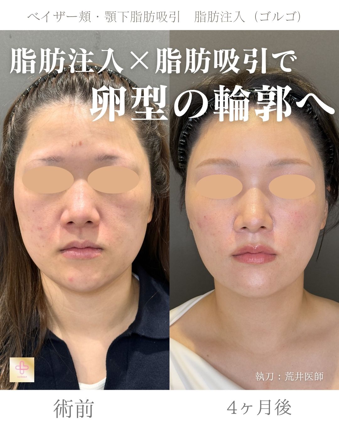 小顔脂肪吸引、ゴルゴ脂肪注入