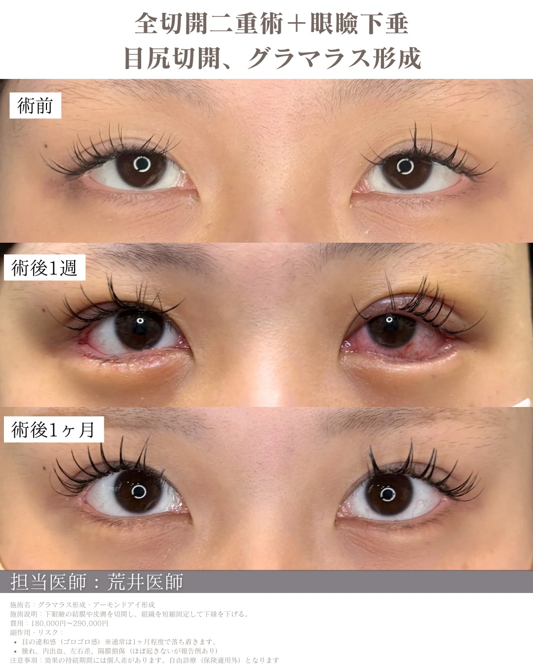 目尻切開の症例写真(ビフォーアフター)