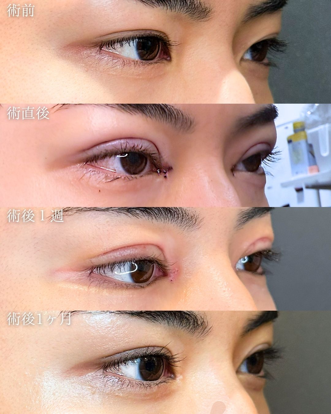 メンズ　二重全切開