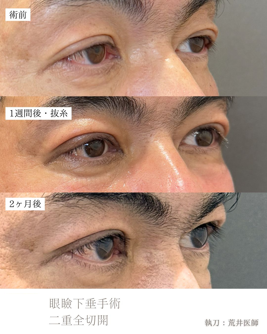 たるみ取り併用二重全切開、眼瞼下垂