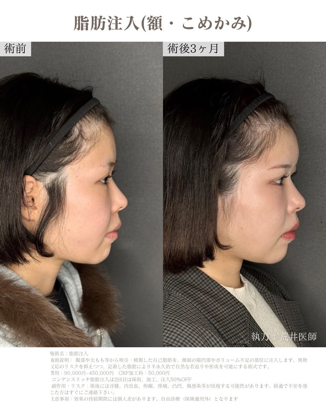 額脂肪注入症例
