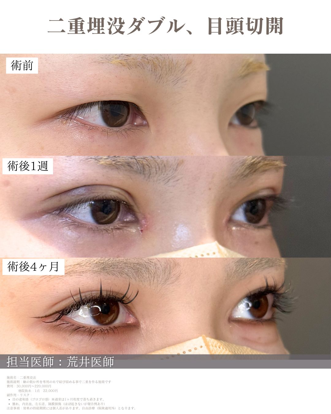目頭切開　二重埋没