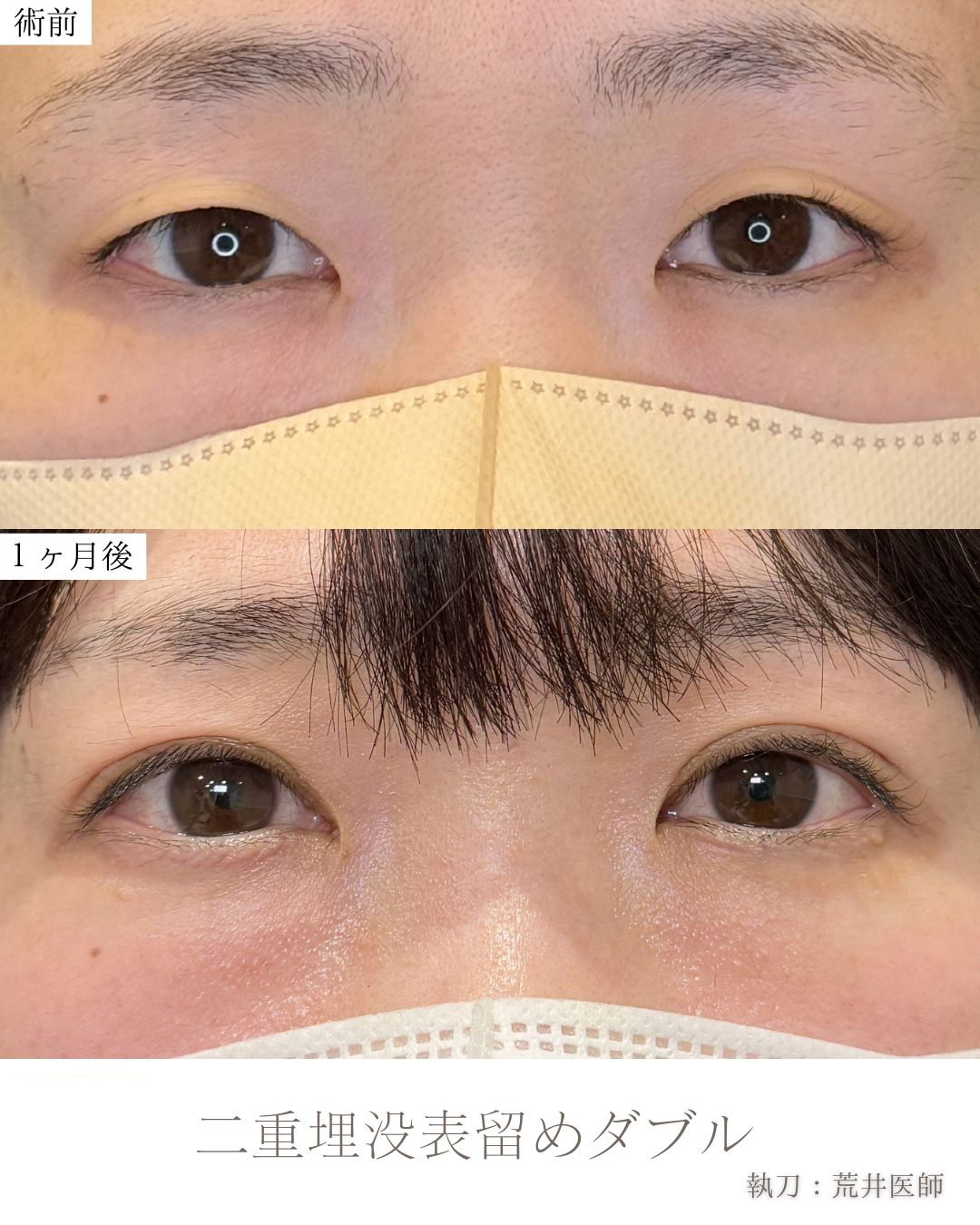 埋没法 表留めダブル