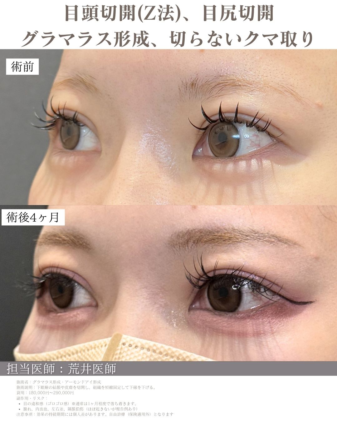 タレ目形成症例