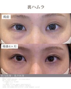 裏ハムラ症例