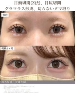 タレ目形成症例