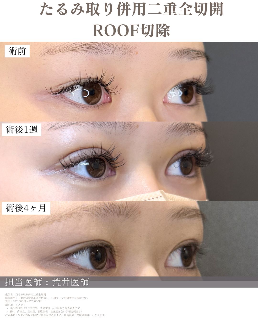 ROOF切除二重全切開症例