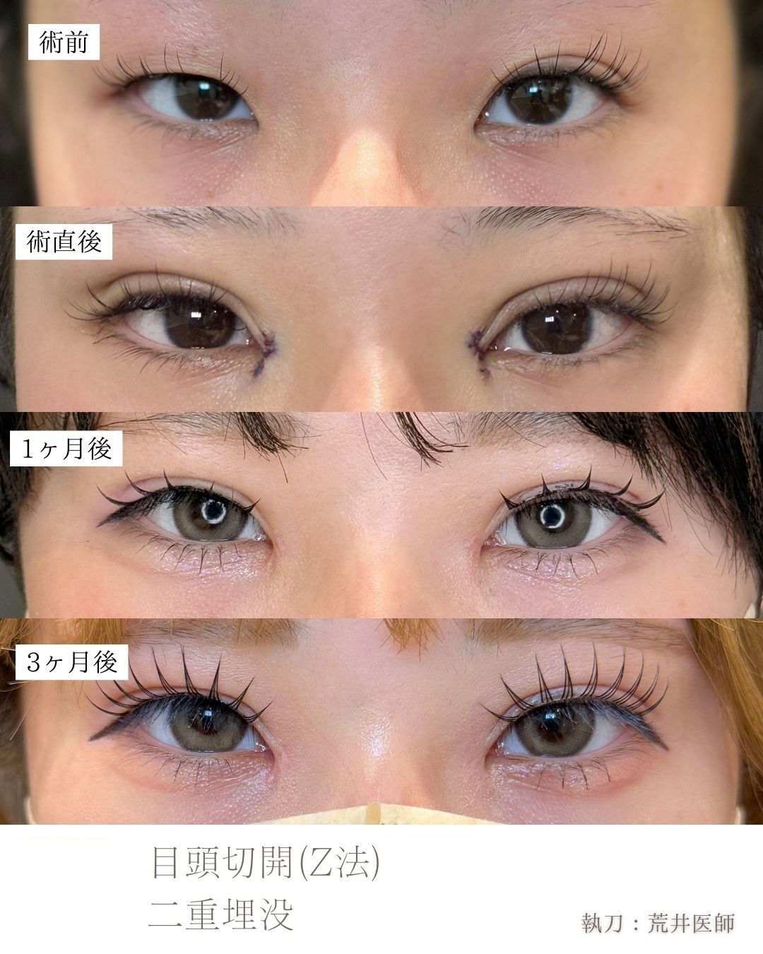 二重埋没症例