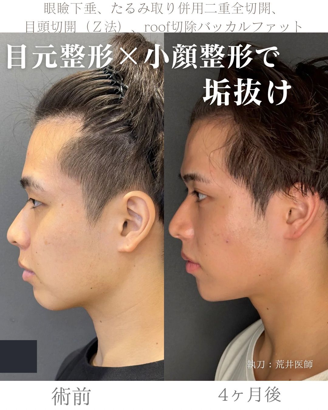 全顔整形症例
