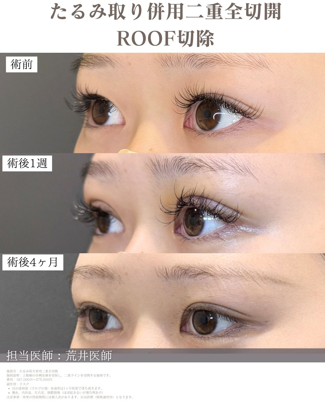 ROOF切除二重全切開症例