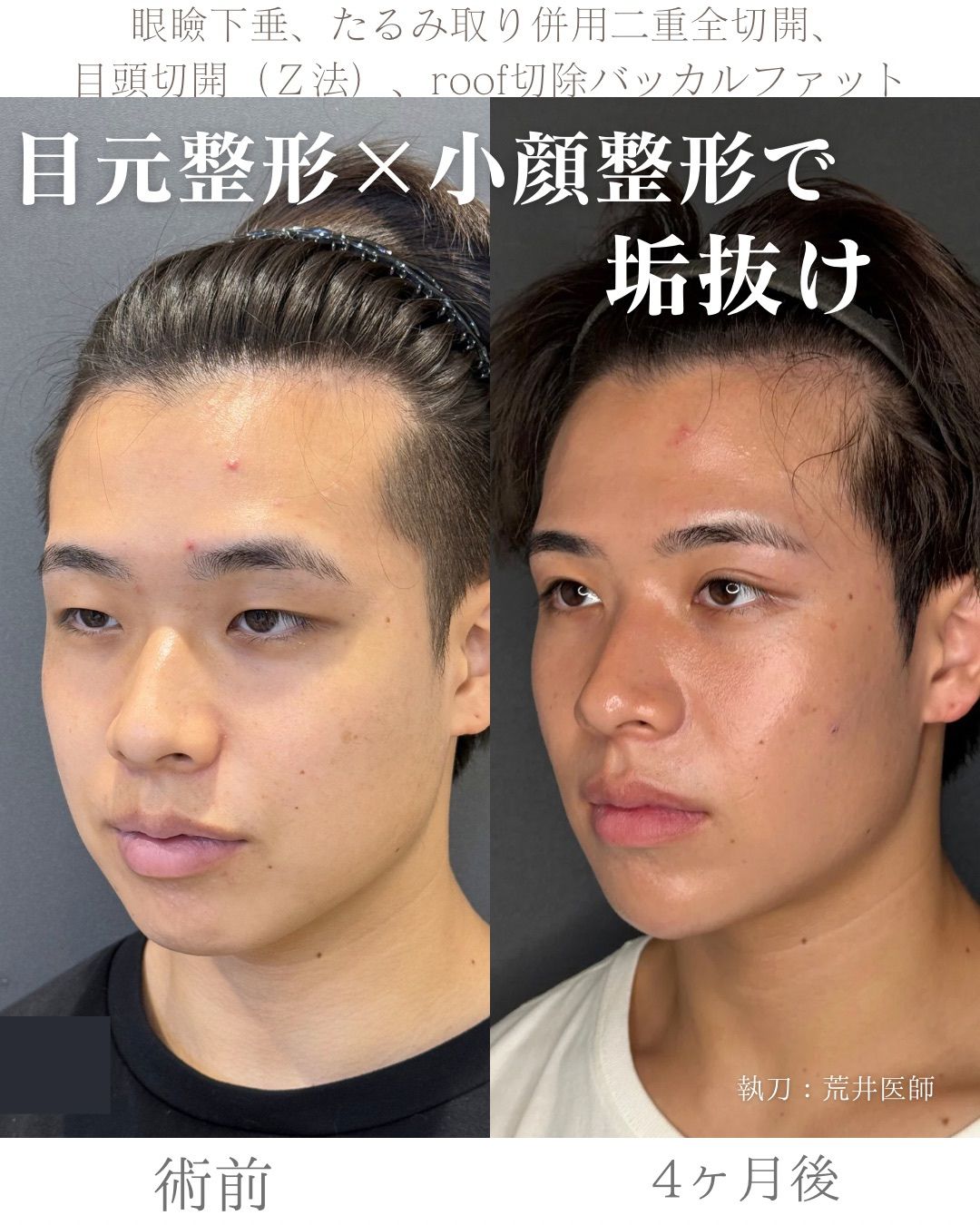 全顔整形症例