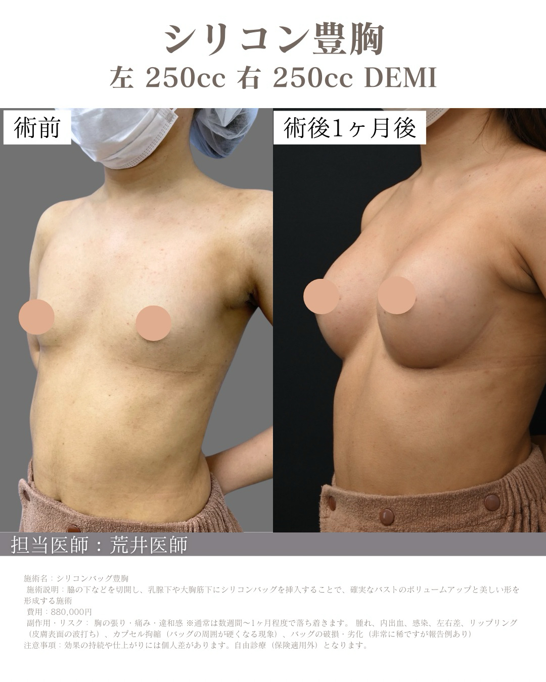 シリコンバッグ豊胸 症例 ビフォーアフター 正面