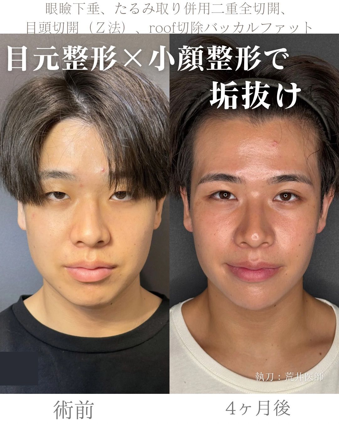 全顔整形症例