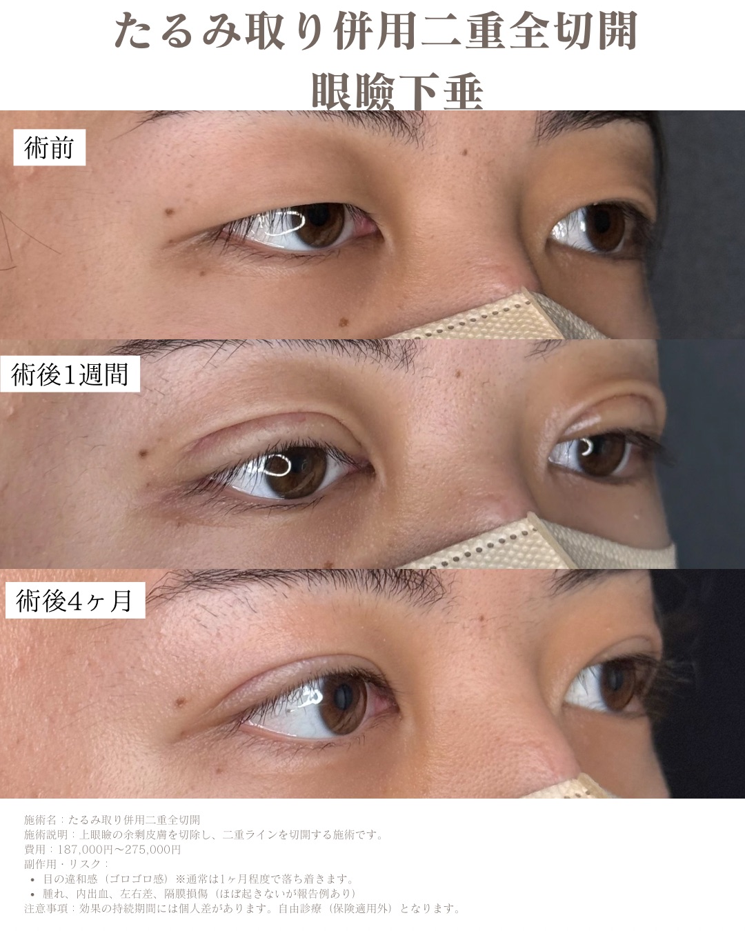 二重全切開症例