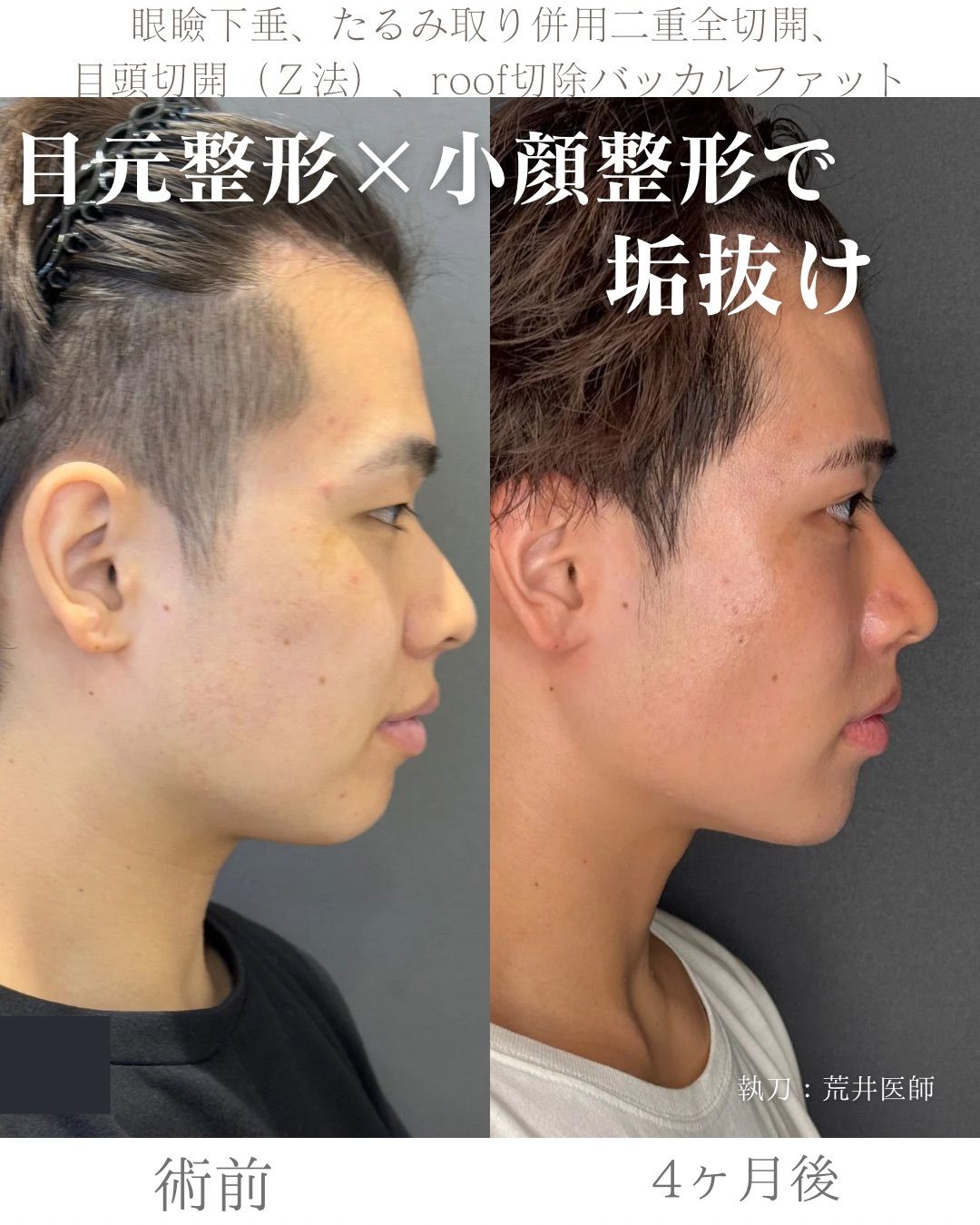 全顔整形症例