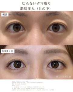 クマ取り整形症例