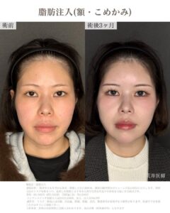 額脂肪注入症例