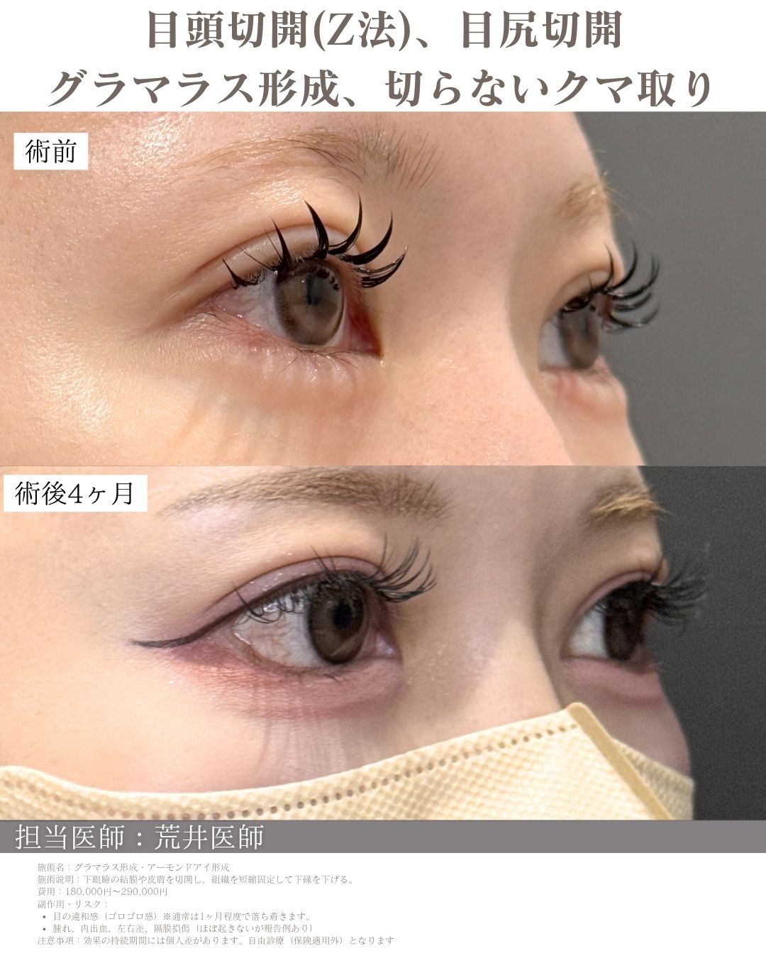 タレ目形成症例