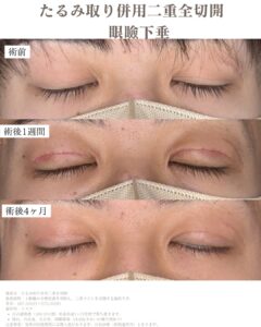 男性は奥二重が似合う？