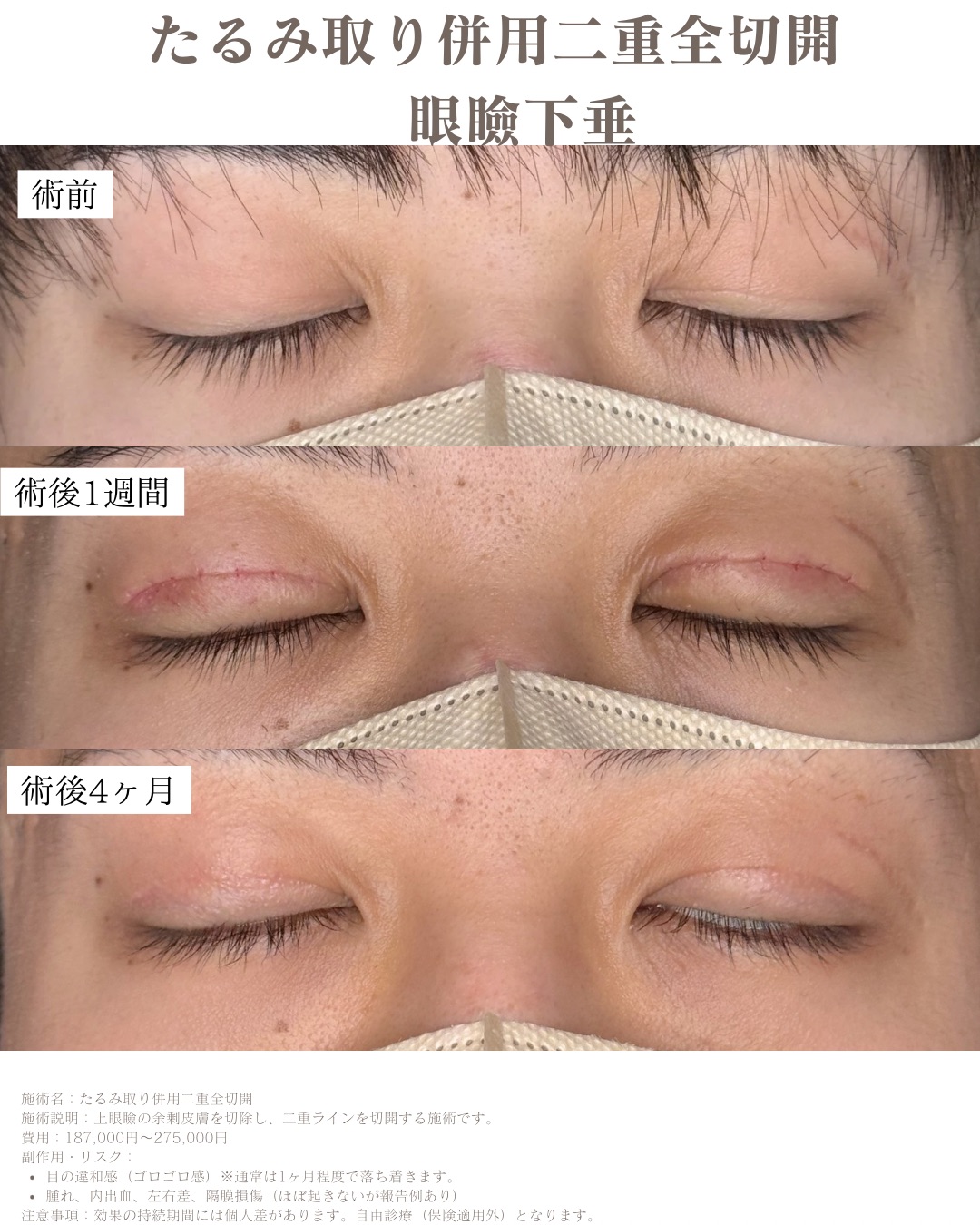 男性は奥二重が似合う？