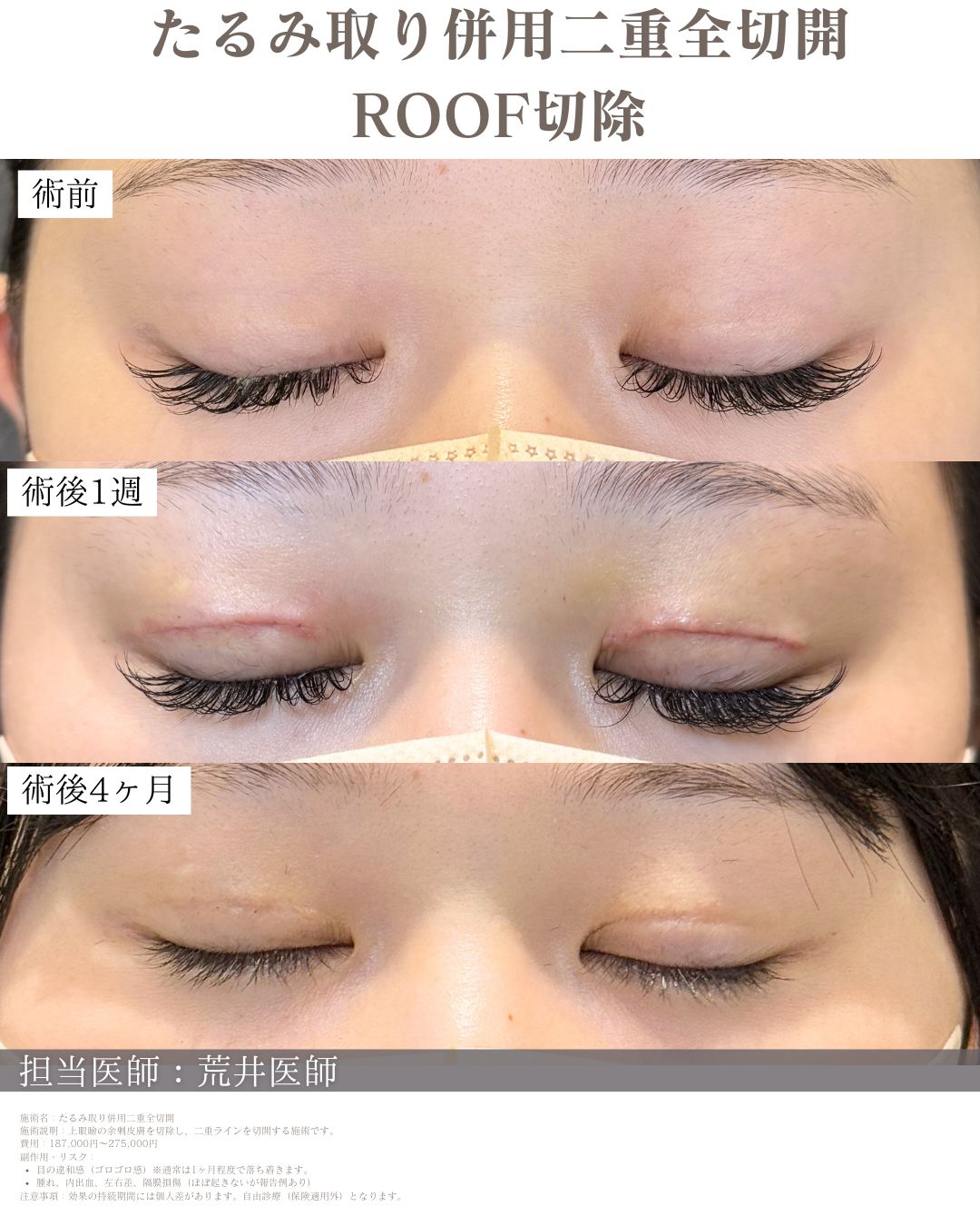 ROOF切除二重全切開症例