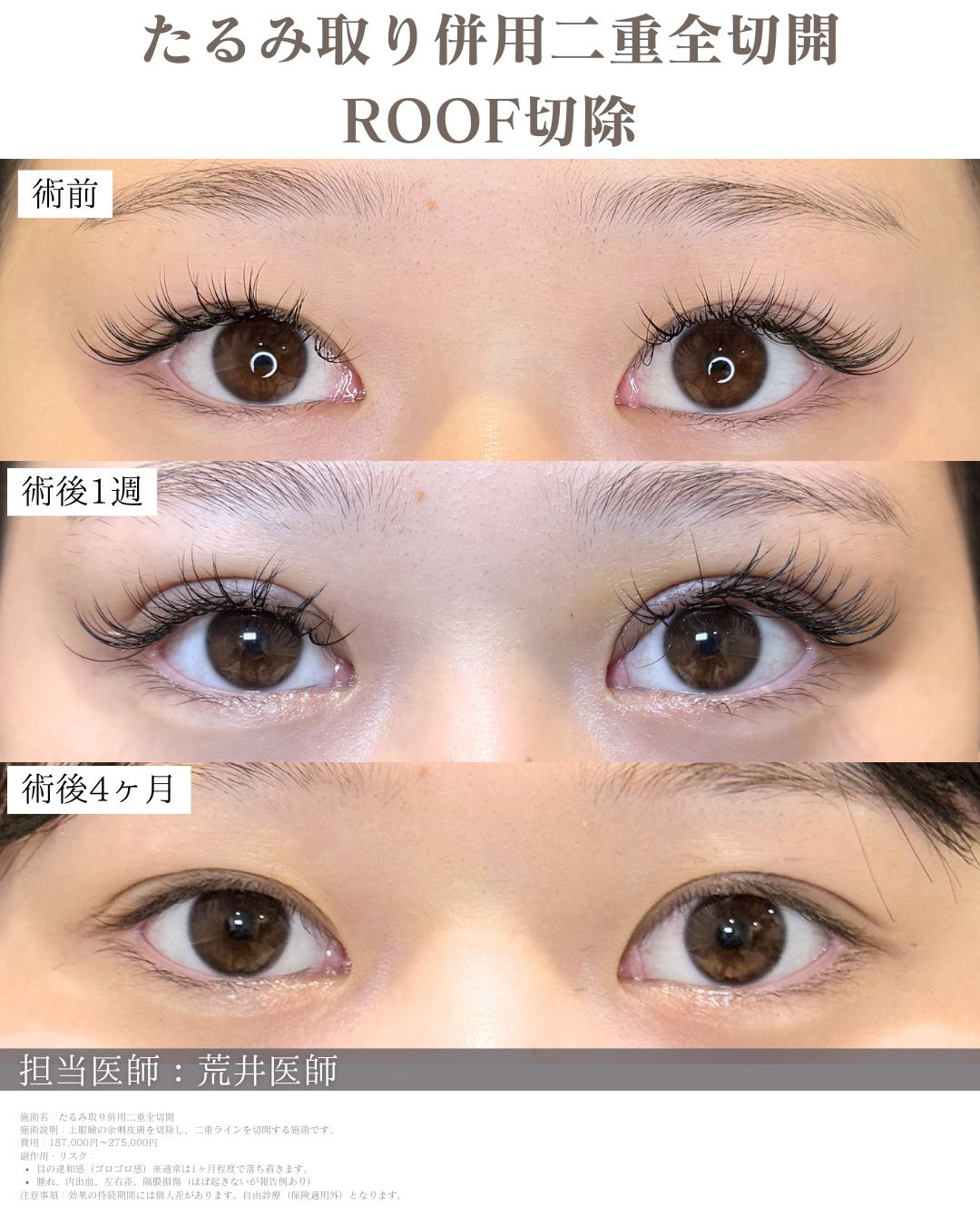 ROOF切除二重全切開症例