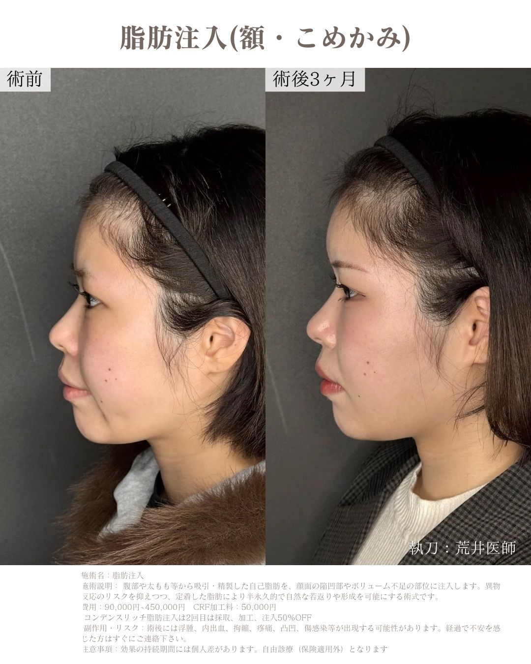 額脂肪注入症例