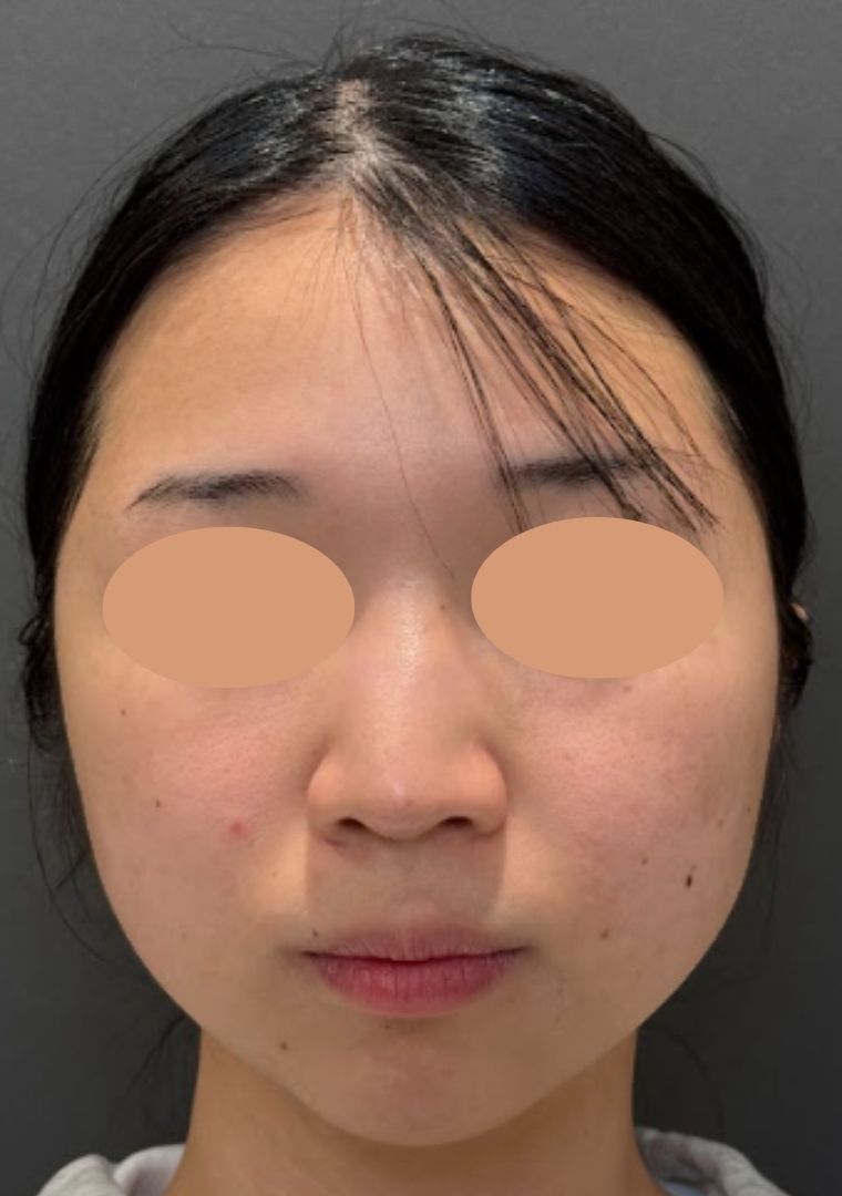 20代女性の小顔脂肪吸引（頬・顎下・ジョールファット）の症例経過。術前の状態から、術後翌日のダウンタイム（腫れや内出血）のリアルな様子、術後4ヶ月の自然で綺麗なフェイスラインが完成するまでの比較写真。