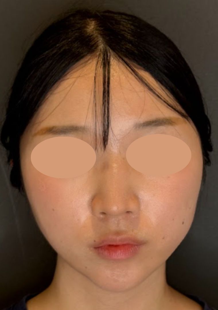 20代女性の小顔脂肪吸引（頬・顎下・ジョールファット）の症例経過。術前の状態から、術後翌日のダウンタイム（腫れや内出血）のリアルな様子、術後4ヶ月の自然で綺麗なフェイスラインが完成するまでの比較写真。