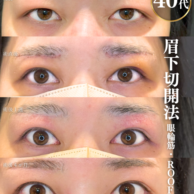 alt=40代女性の眉下切開・ROOF切除・眼輪筋切除　術前と４か月後の比較症例