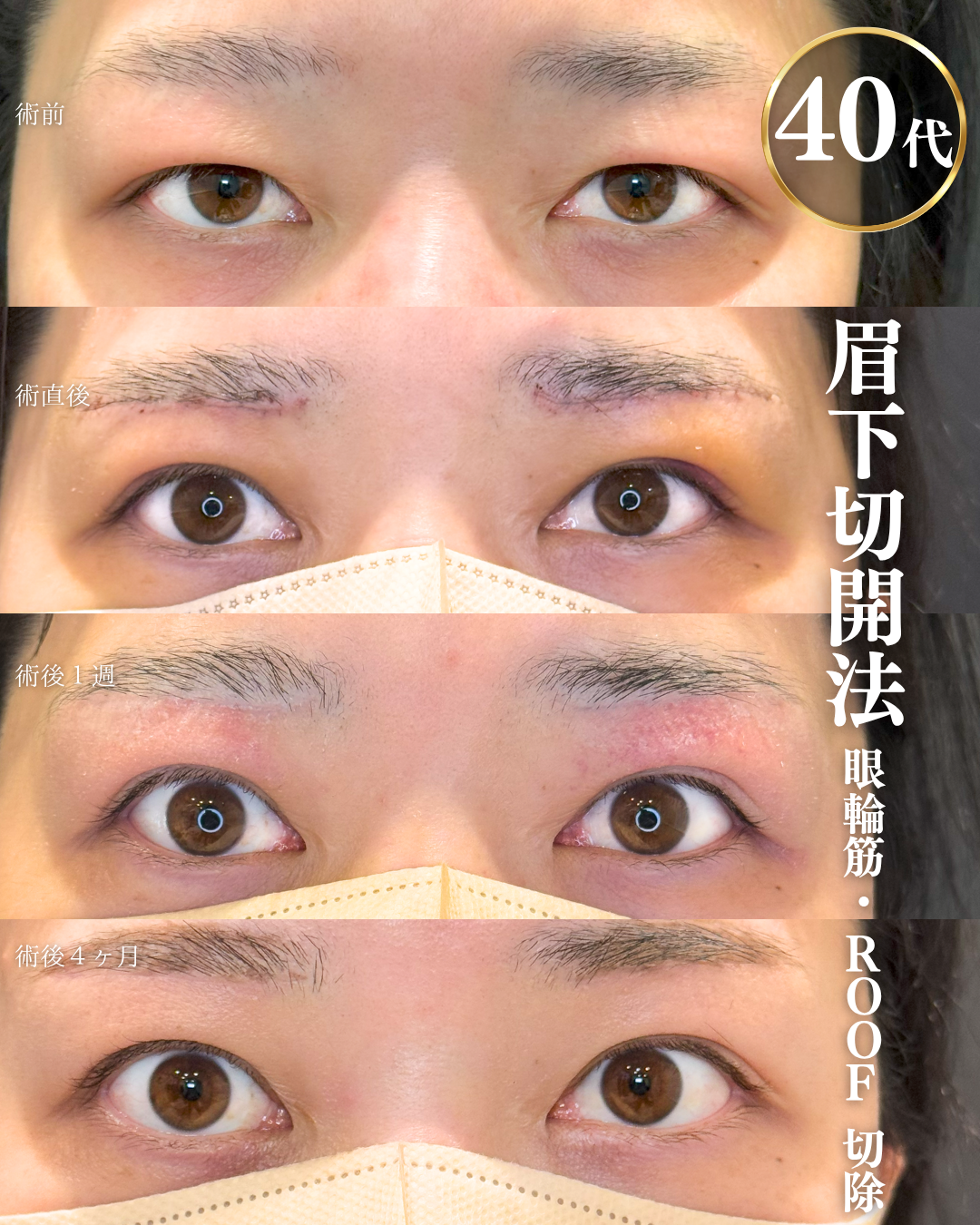 alt=40代女性の眉下切開・ROOF切除・眼輪筋切除　術前と４か月後の比較症例