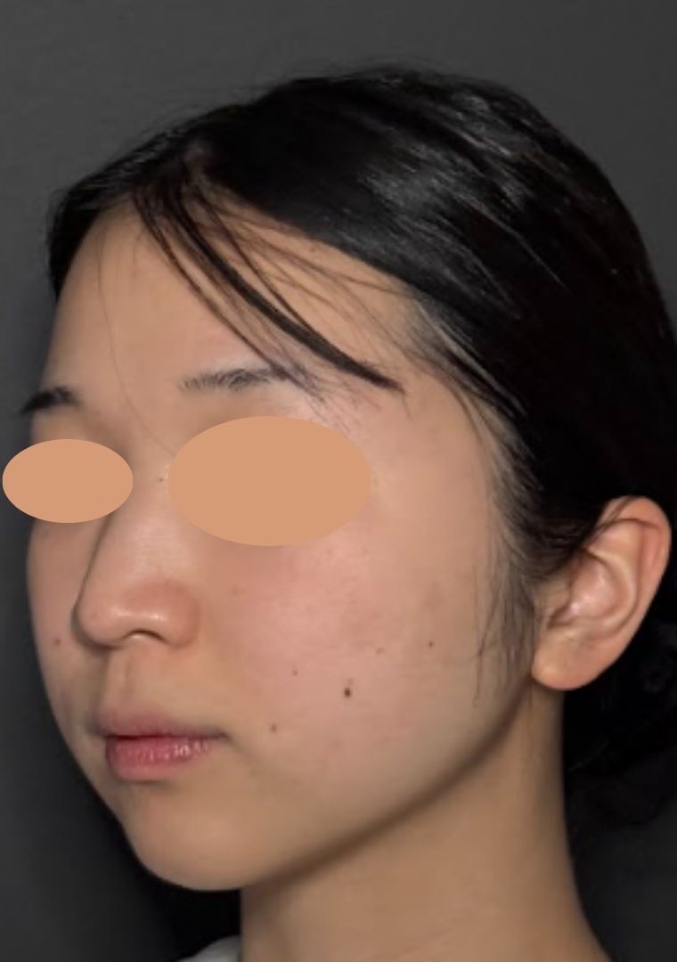 20代女性の小顔脂肪吸引（頬・顎下・ジョールファット）の症例経過。術前の状態から、術後翌日のダウンタイム（腫れや内出血）のリアルな様子、術後4ヶ月の自然で綺麗なフェイスラインが完成するまでの比較写真。