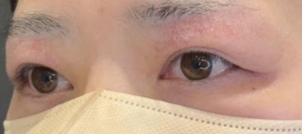 術後1ヶ月