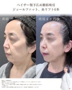 50代小顔脂肪吸引