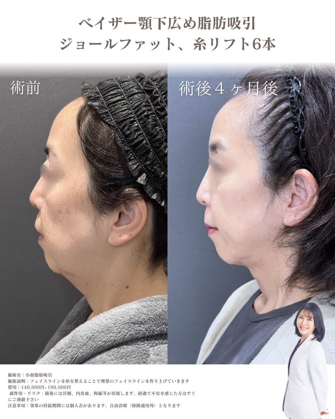 50代小顔脂肪吸引