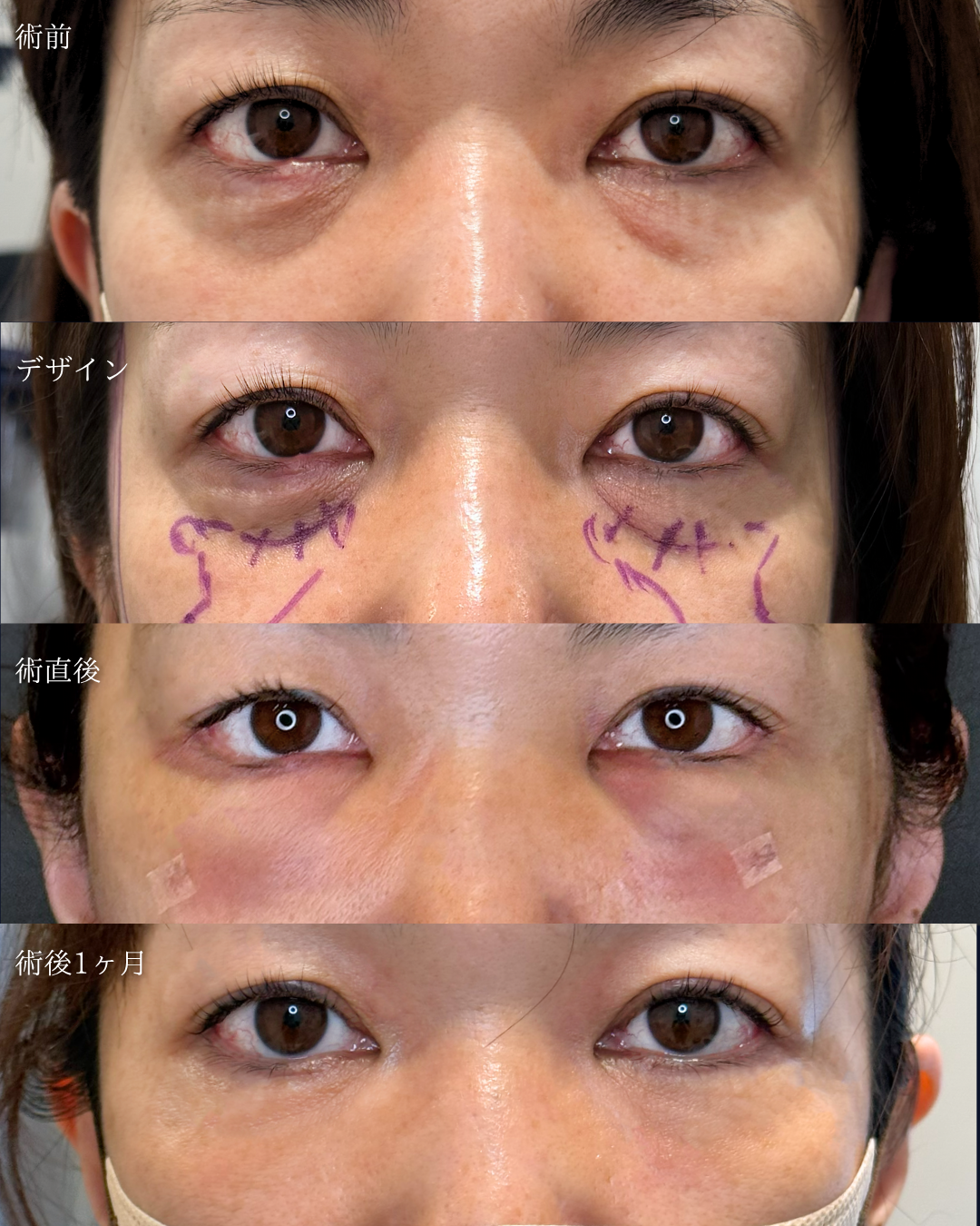 alt=40代女性の裏ハムラ　術前と一ヶ月後の比較症例