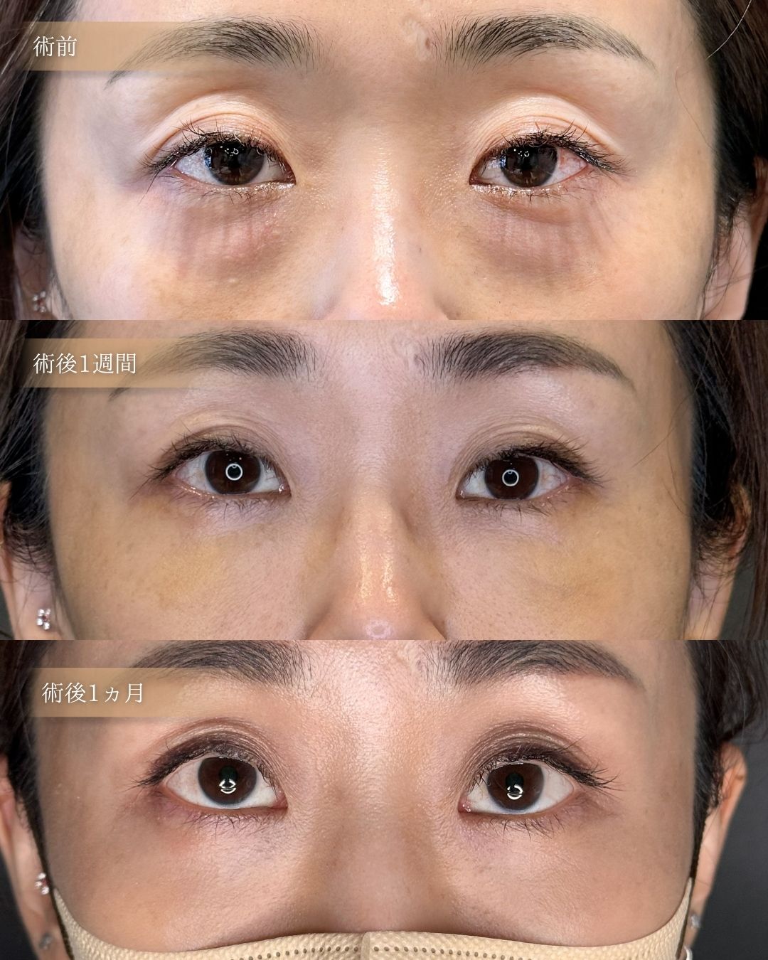裏ハムラ法によるクマ取りの症例Before/After写真。担当：荒井香織医師。