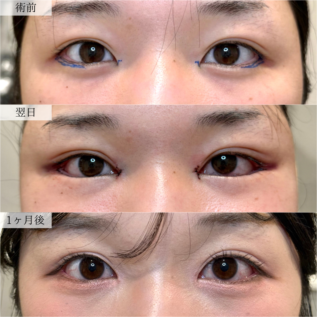 20代女性の目尻延長切開の症例です。術前と術後1か月の写真で、目尻の形や目元の横幅の変化をご覧いただけます。