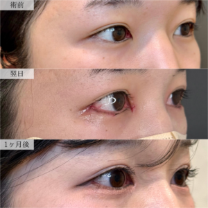 20代女性の目尻延長切開の症例です。術前と術後1か月の写真で、目尻の形や目元の横幅の変化をご覧いただけます。