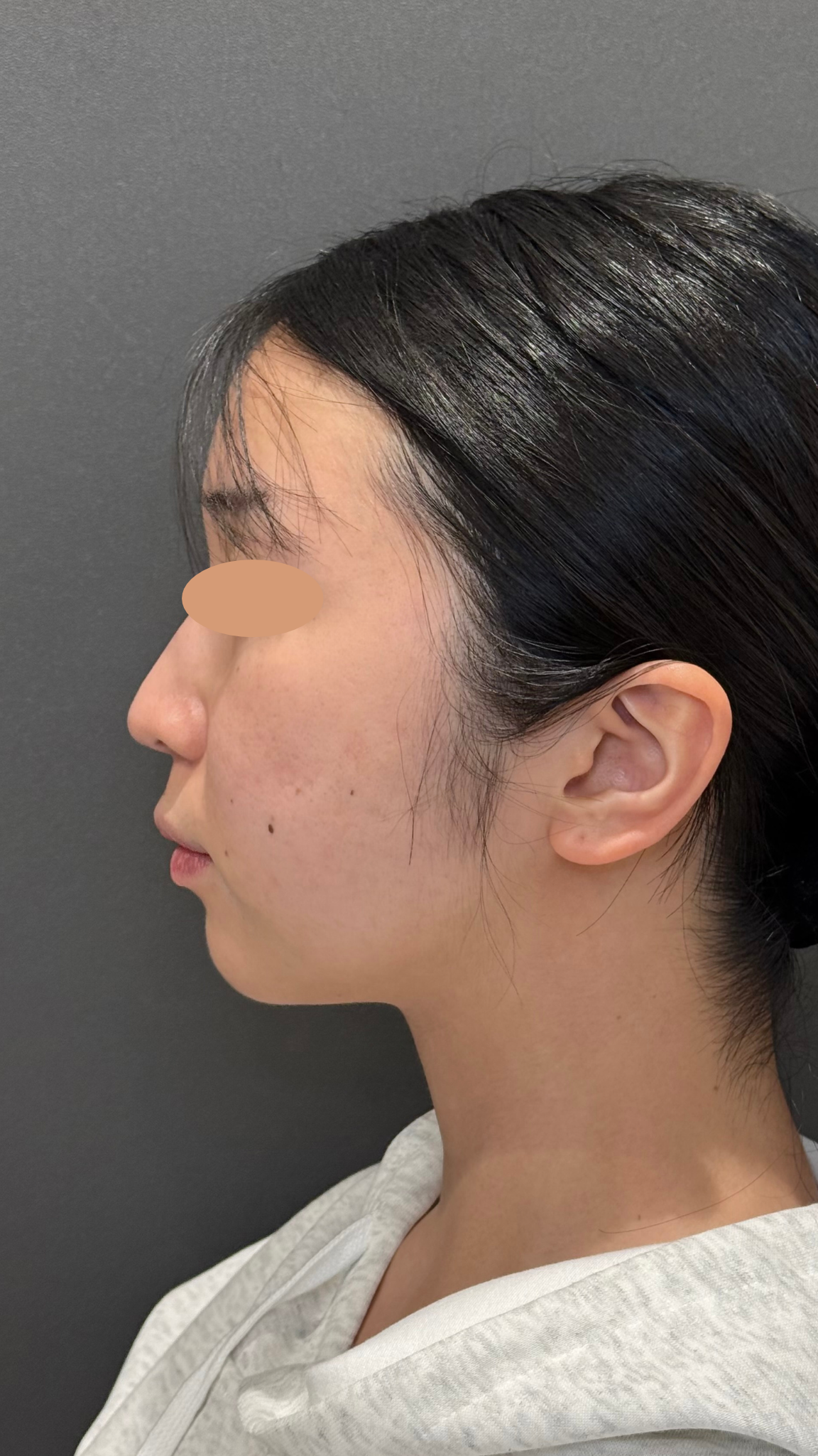 20代女性の小顔脂肪吸引（頬・顎下・ジョールファット）の症例経過。術前の状態から、術後翌日のダウンタイム（腫れや内出血）のリアルな様子、術後4ヶ月の自然で綺麗なフェイスラインが完成するまでの比較写真。