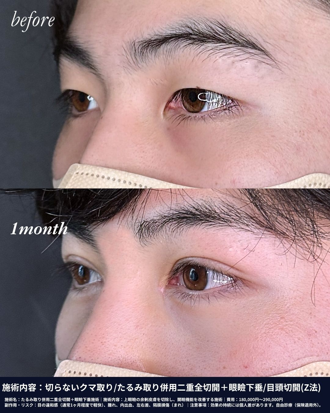 KAOクリニック銀座東京のたるみ取り併用二重全切開＋眼瞼下垂施術の症例写真。上まぶたの余剰皮膚を切除し、目の開きを改善する施術のビフォーアフター。