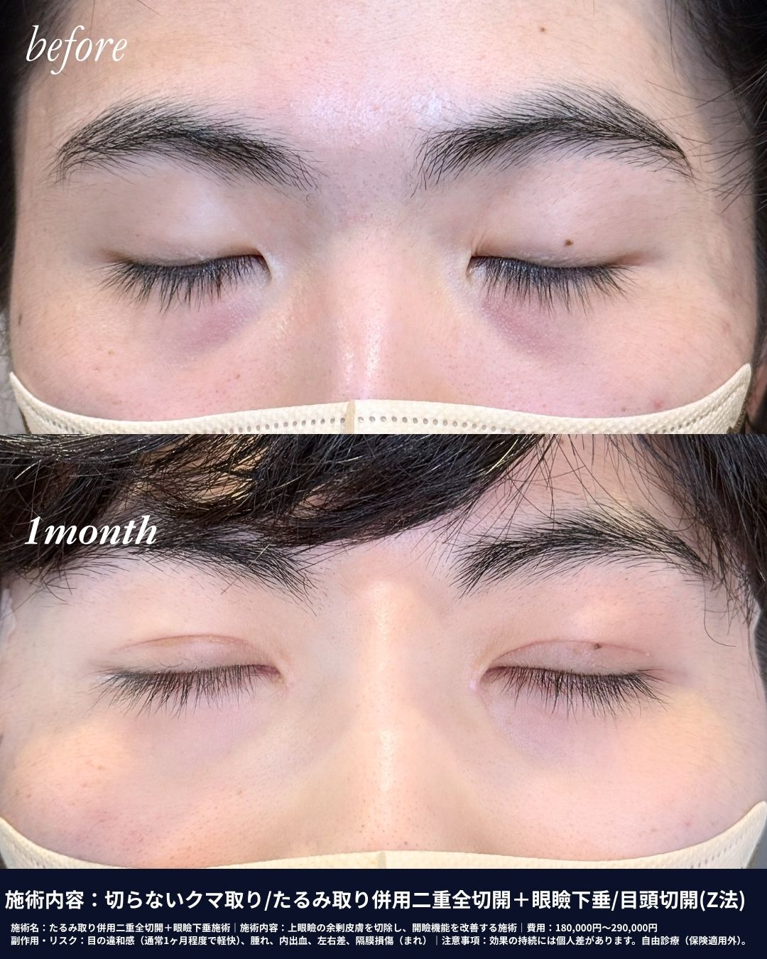 KAOクリニック銀座東京のたるみ取り併用二重全切開＋眼瞼下垂施術の症例写真。上まぶたの余剰皮膚を切除し、目の開きを改善する施術のビフォーアフター。