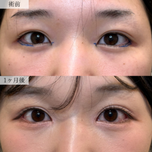 20代女性の目尻延長切開の症例です。術前と術後1か月の写真で、目尻の形や目元の横幅の変化をご覧いただけます。